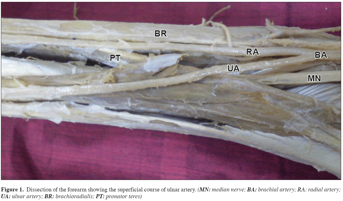 Anatomical-Variations-course-ulnar-artery