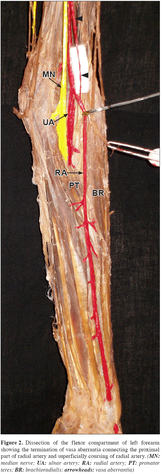 Anatomical-Variations-coursing-radial-artery