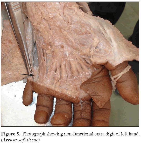 Anatomical-Variations-digit-left-hand
