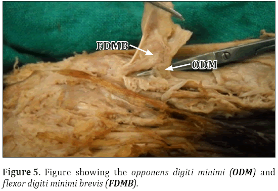 Anatomical-Variations-digiti-minimi-brevis