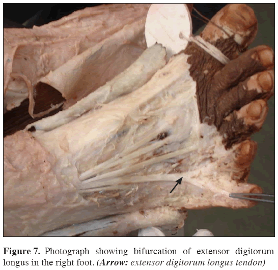 Anatomical-Variations-digitorum-longus-tendon