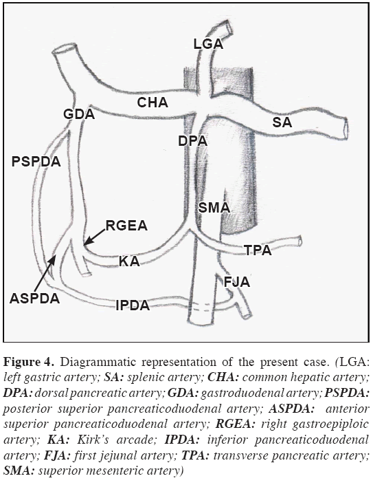 Anatomical-Variations-dorsal-pancreatic-artery
