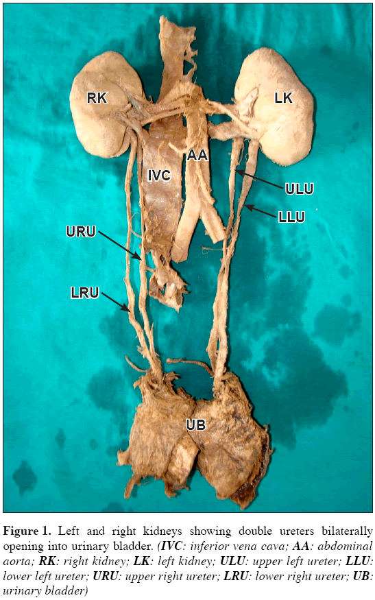 Anatomical-Variations-double-ureters-bilaterally