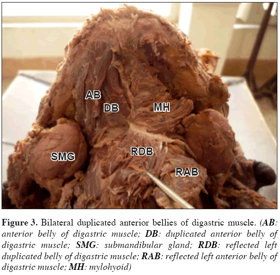 Anatomical-Variations-duplicated-anterior-bellies