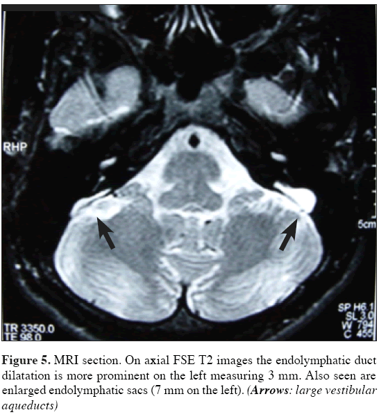 Anatomical-Variations-enlarged-endolymphatic-sacs
