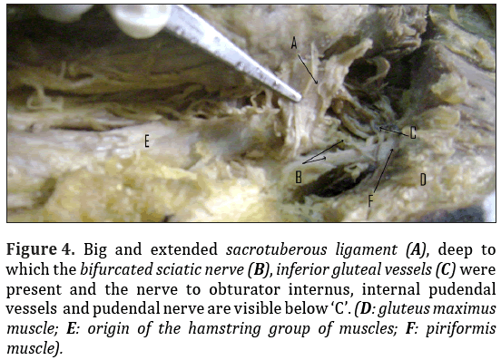 Anatomical-Variations-extended-sacrotuberous-ligament