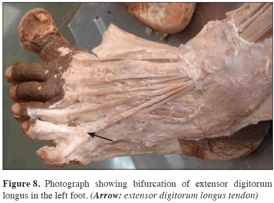Anatomical-Variations-extensor-digitorum-longus