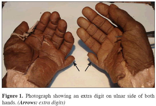 Anatomical-Variations-extra-digit-ulnar-side