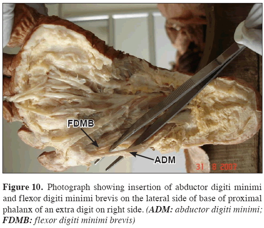 Anatomical-Variations-flexor-digiti-minimi