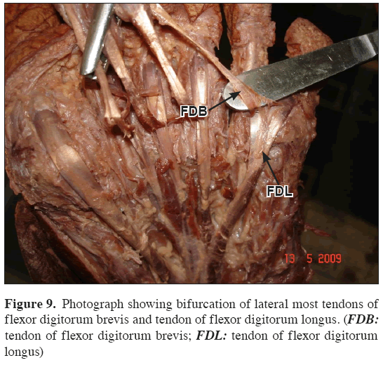 Anatomical-Variations-flexor-digitorum-brevis