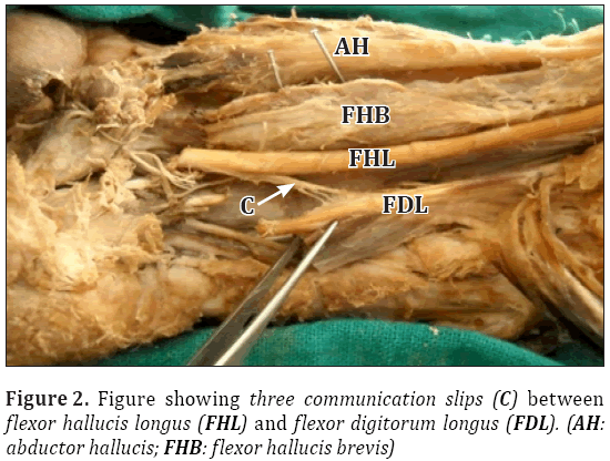 Anatomical-Variations-flexor-digitorum-longus