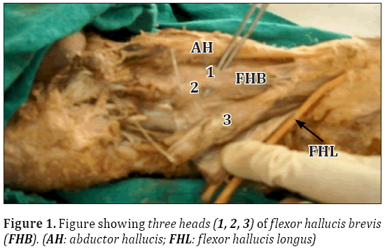 Anatomical-Variations-flexor-hallucis-longus