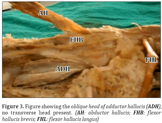 Anatomical-Variations-head-adductor-hallucis