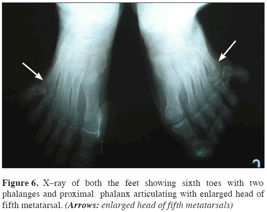 Anatomical-Variations-head-fifth-metatarsals