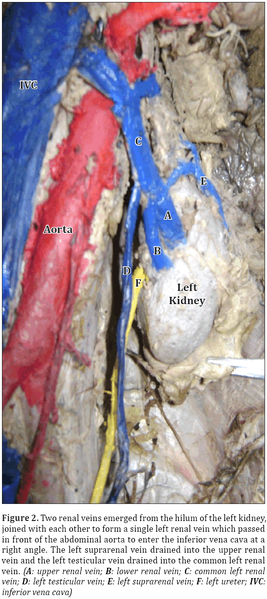 Anatomical-Variations-hilum-left-kidney