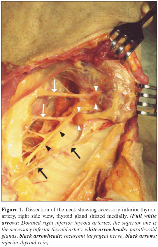 Anatomical-Variations-inferior-thyroid-arteries
