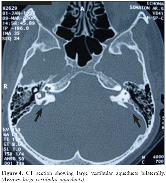 Anatomical-Variations-large-vestibular-aqueducts