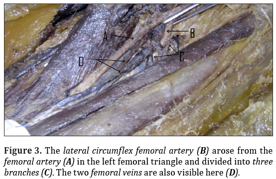 Anatomical-Variations-lateral-circumflex-femoral