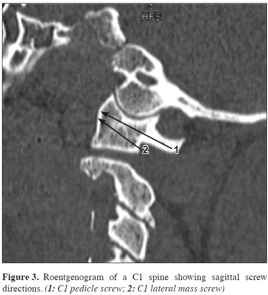 Anatomical-Variations-lateral-mass-screw