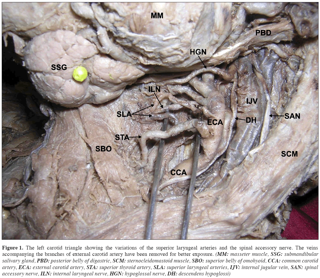 Anatomical-Variations-left-carotid-triangle