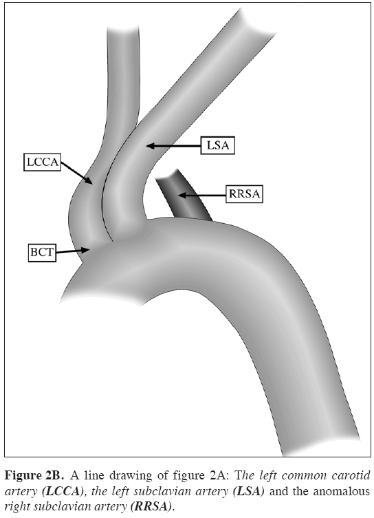 Anatomical-Variations-left-common-carotid