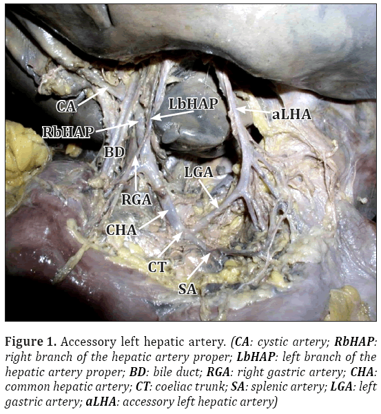 Anatomical-Variations-left-hepatic-artery
