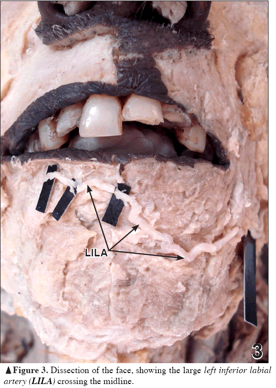 Anatomical-Variations-left-inferior-labial