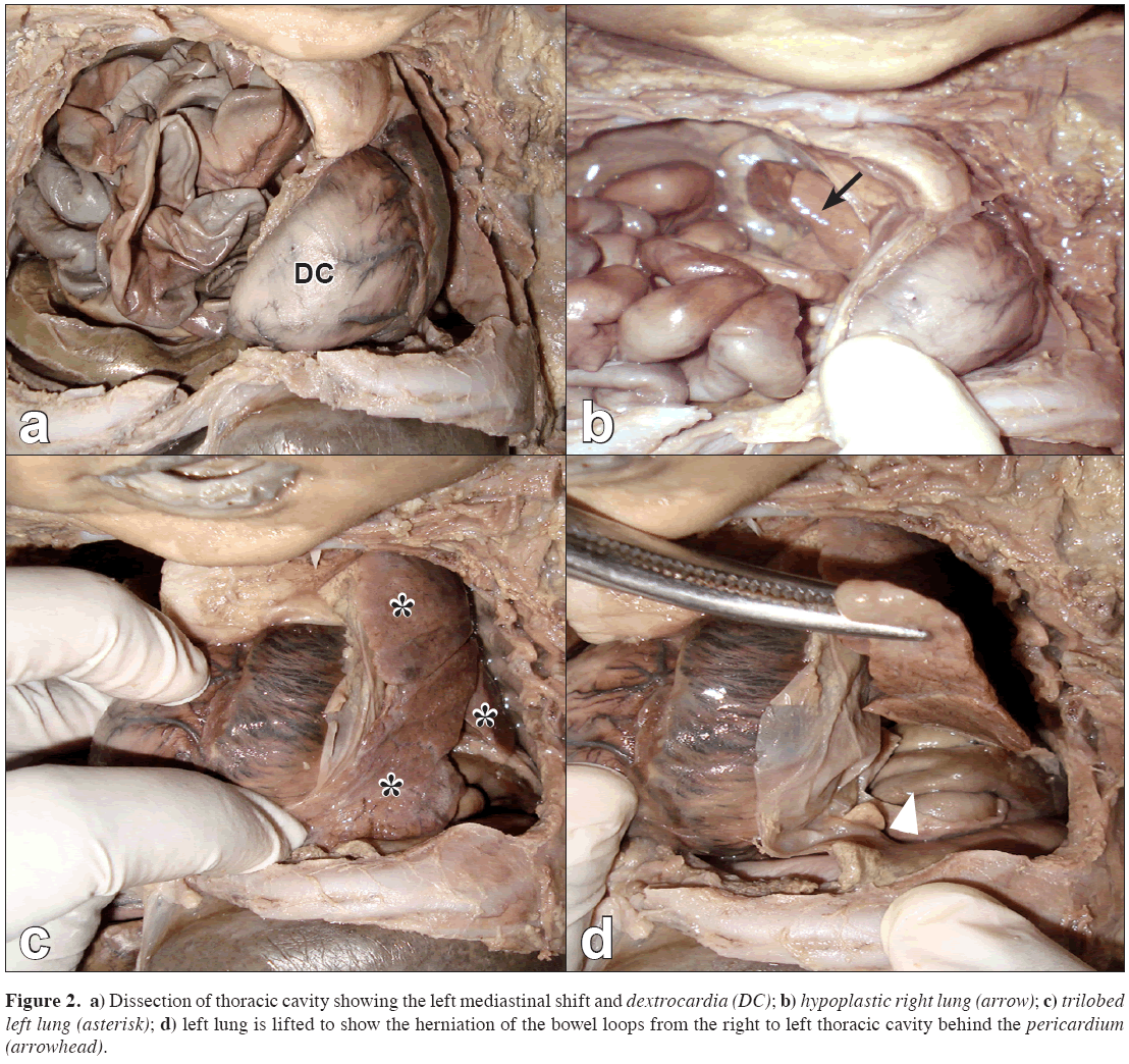 Anatomical-Variations-left-lung-lifted
