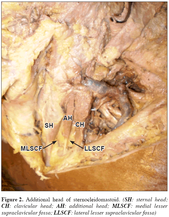 Multiple Variations In Neck Musculature And Their Surgical Implications