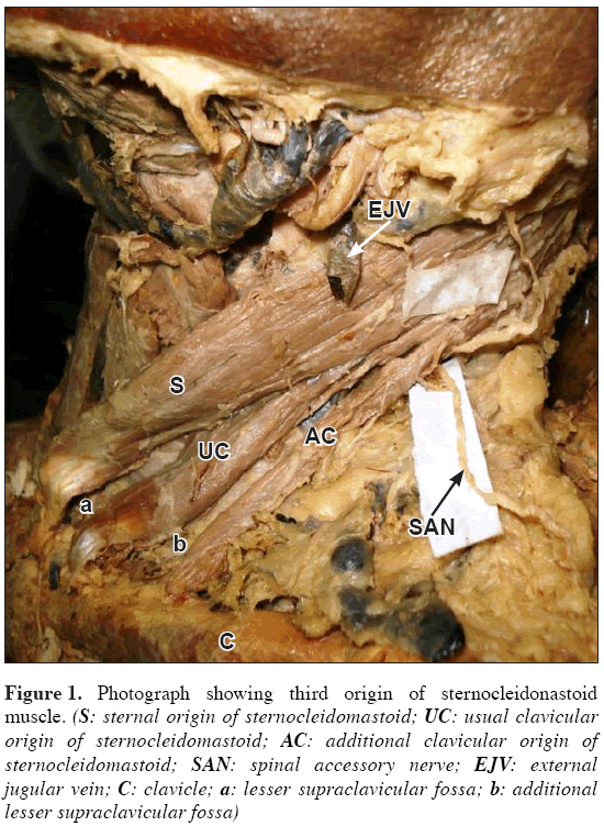 Anatomical-Variations-lesser-supraclavicular-fossa