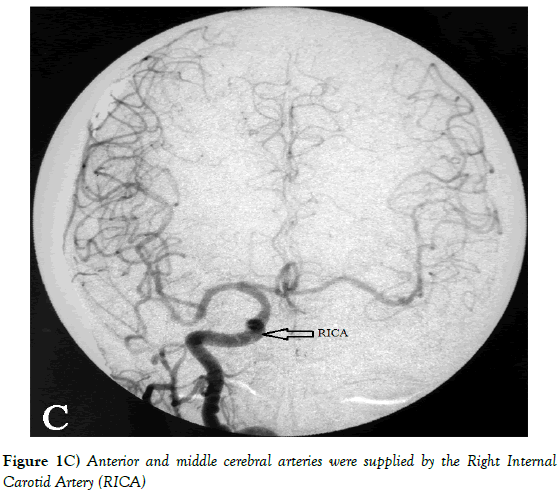 Anatomical-Variations-middle-cerebral-arteries