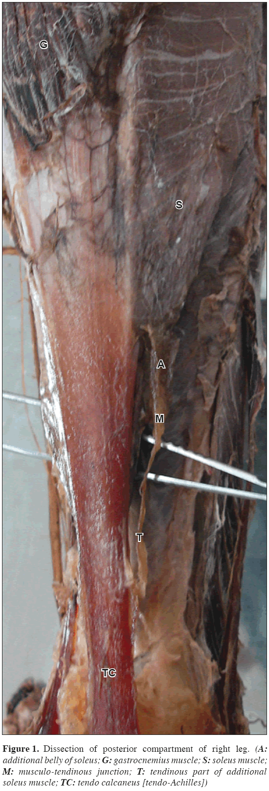 Anatomical-Variations-musculo-tendinous-junction