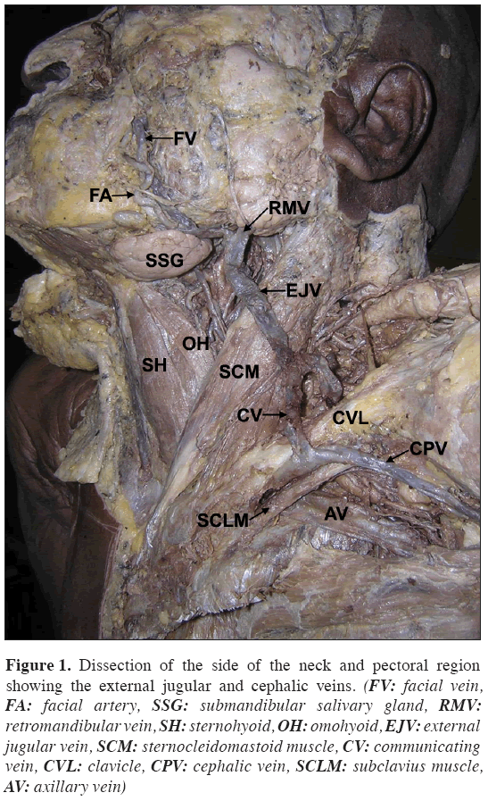 Abnormal Formation And Communication Of External Jugular Vein