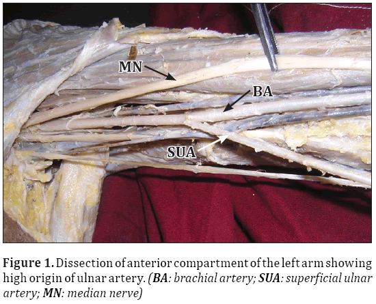 Anatomical-Variations-origin-ulnar-artery