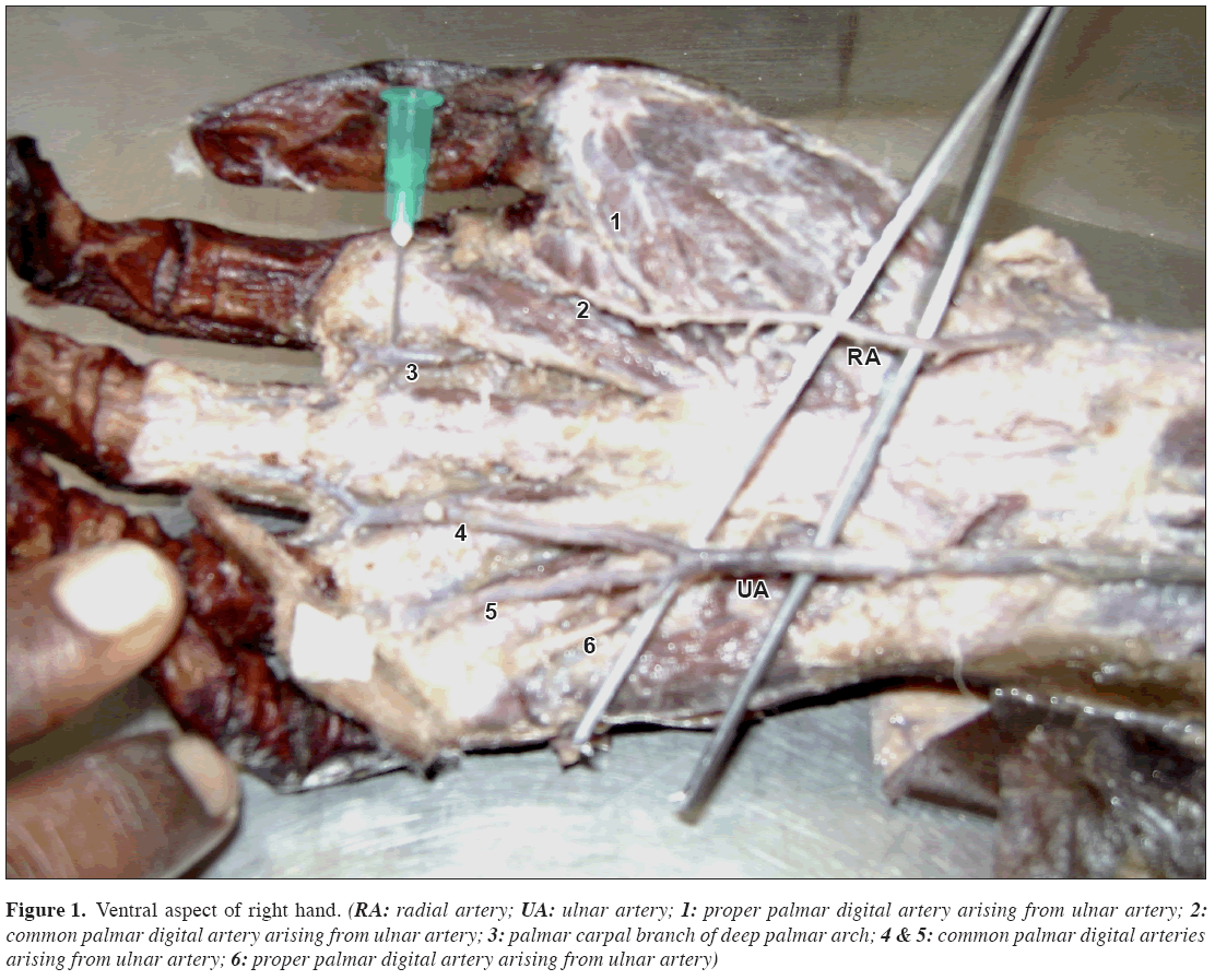 Anatomical-Variations-palmar-digital-artery