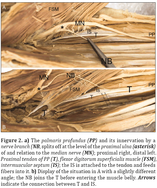 Anatomical-Variations-palmaris-profundus