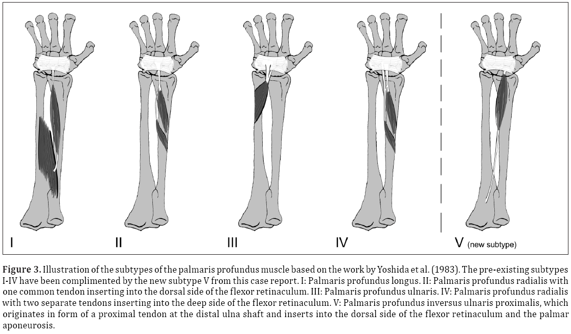 Anatomical-Variations-palmaris-profundus-muscle