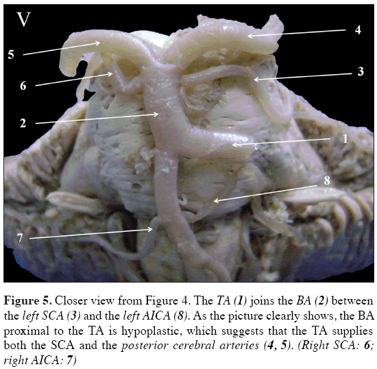Anatomical-Variations-posterior-cerebral-arteries