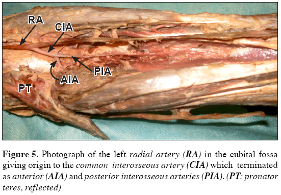 Anatomical-Variations-posterior-interosseous-arteries