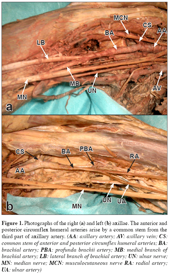 Anatomical-Variations-profunda-brachii-artery