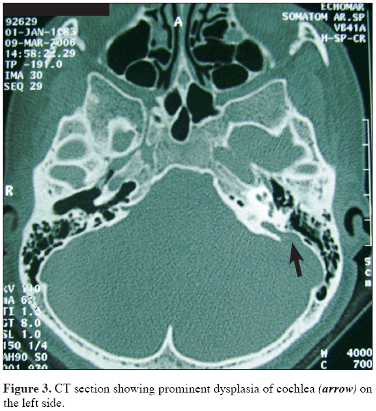 Anatomical-Variations-prominent-dysplasia-cochlea