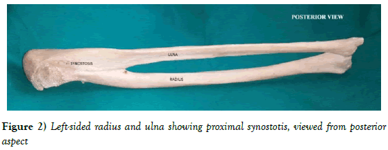 Anatomical-Variations-proximal-synostotis