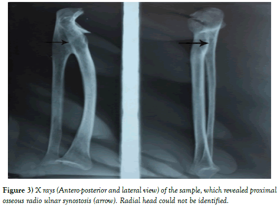 Anatomical-Variations-radio-ulnar-synostosis