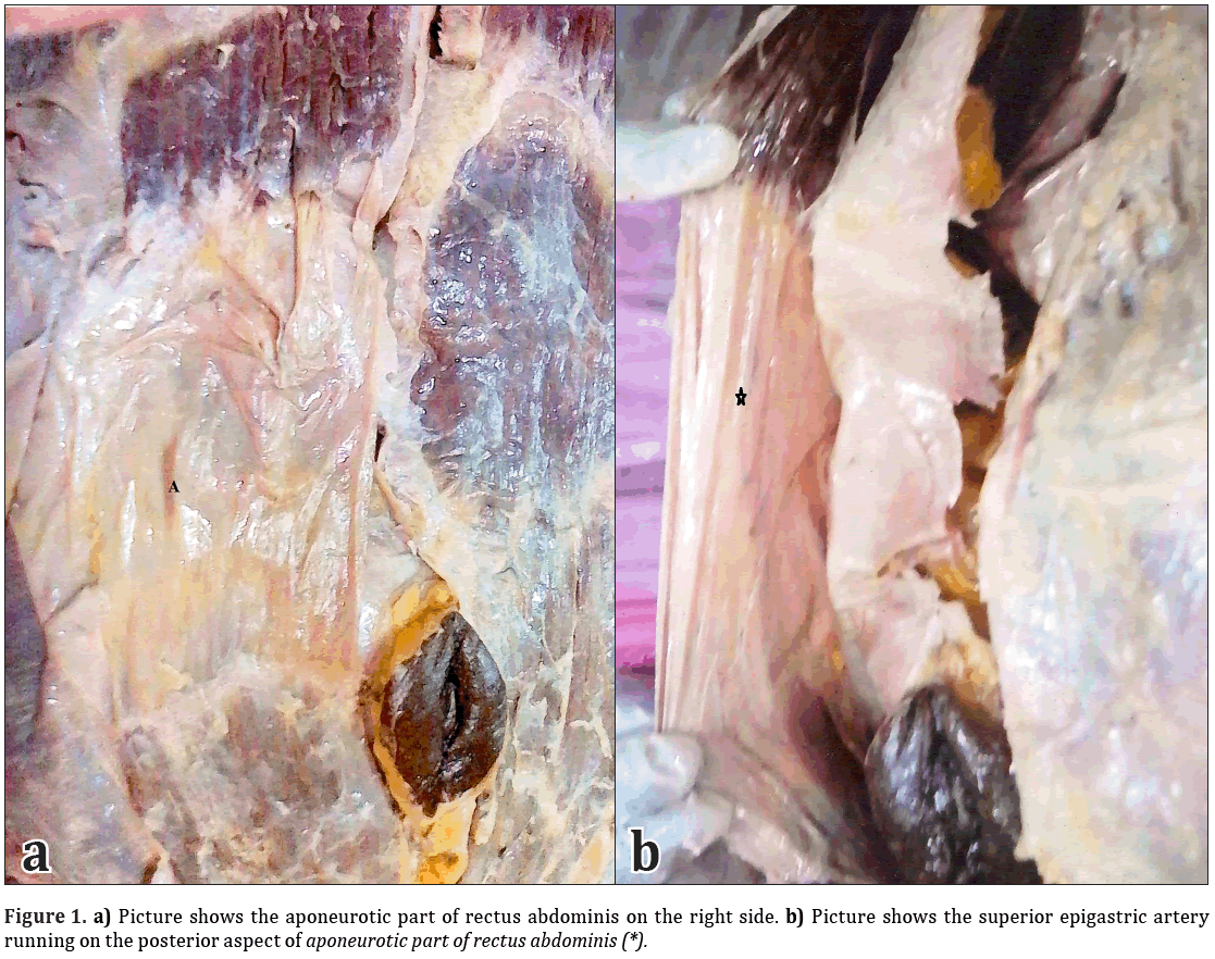 Anatomical-Variations-rectus-abdominis