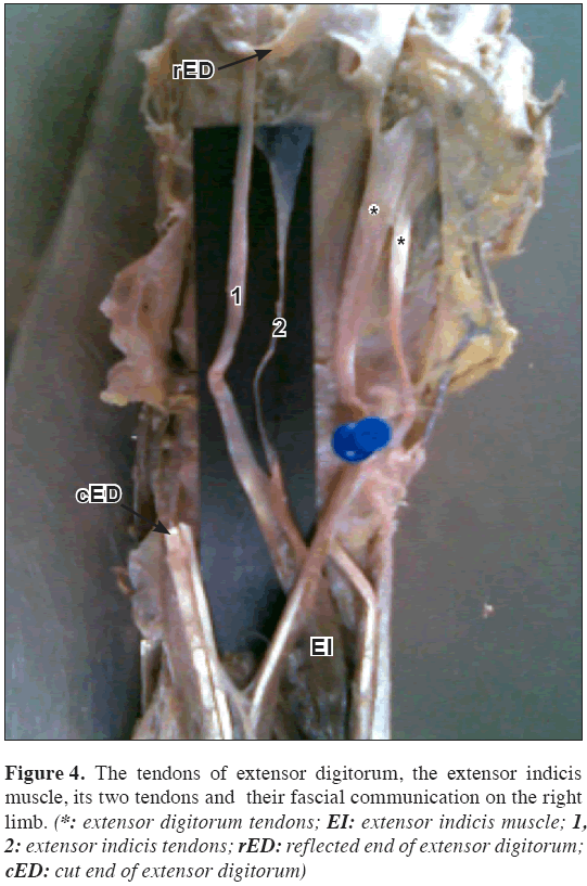 Anatomical-Variations-reflected-end-extensor