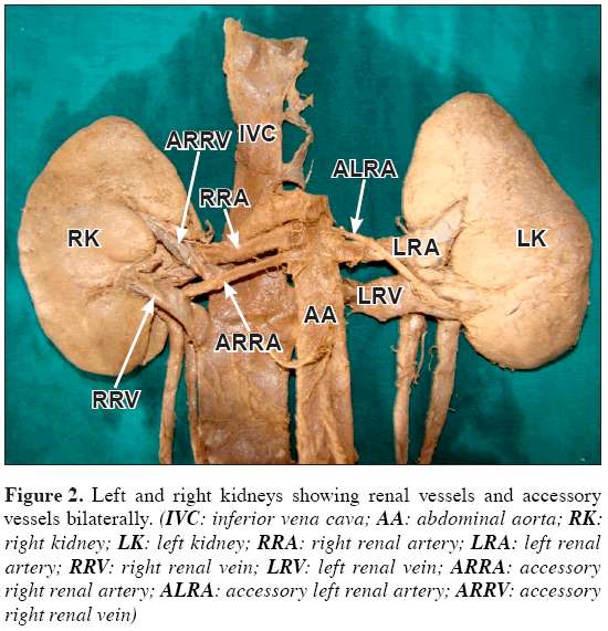 Anatomical-Variations-renal-vessels-accessory