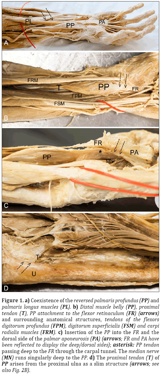 Anatomical-Variations-reversed-palmaris-profundus