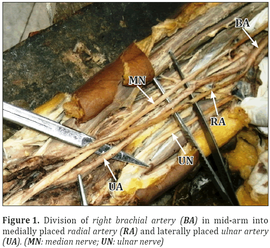 Anatomical-Variations-right-brachial-artery