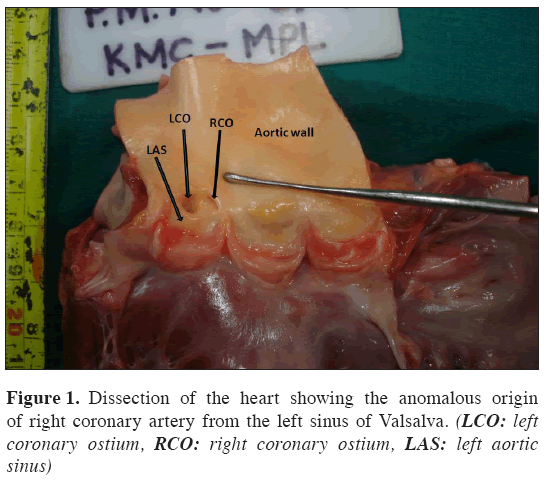 Anatomical-Variations-right-coronary-ostium