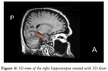 Anatomical-Variations-right-hippocampus-created